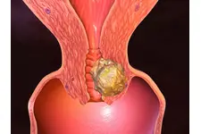 Aşılama Sonrası Kanama Belirtileri ve Tedavisi