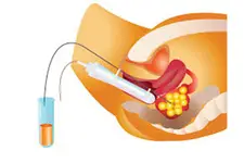 Aşılama Yöntemleri Nelerdir? Aşılama Yöntemleri Nelerdir?