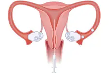 Aşılama Türleri ve Özellikleri